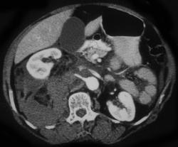 Perirenal Hematoma - CTisus CT Scan