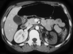 Renal Infarction Due to Renal Artery Injury - CTisus CT Scan