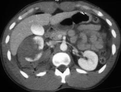 Renal Laceration - CTisus CT Scan