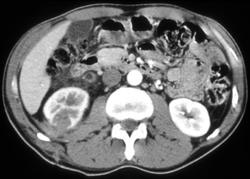 Renal Laceration and Clot in Renal Pelvis - CTisus CT Scan