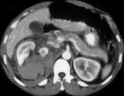 Renal Laceration - CTisus CT Scan