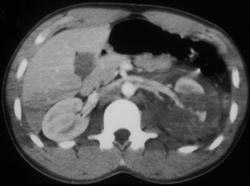 Extensive Renal Trauma With Rupture - CTisus CT Scan