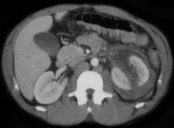 Renal Laceration With Contrast Extravasation on Delayed Scan - CTisus CT Scan