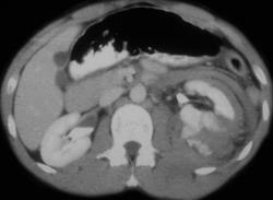 Renal Laceration - CTisus CT Scan