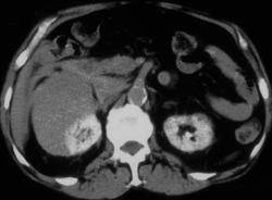 Subcapsular Hematoma With Kidney - CTisus CT Scan