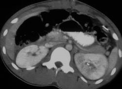 Left Renal Contusion - CTisus CT Scan