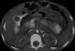 Shock Bowel and Hypoperfusion Due to IVC Injury - CTisus CT Scan