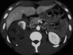 Renal Laceration and Rupture - CTisus CT Scan