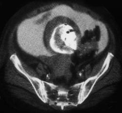 Contrast Extravasation From Bladder Perforation - CTisus CT Scan