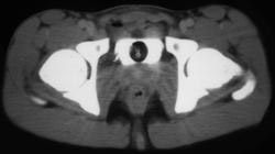 Subtle Bladder Perforation - CTisus CT Scan