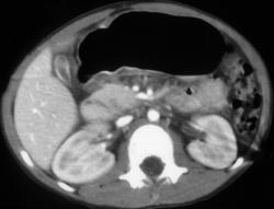 Pancreatic Laceration - CTisus CT Scan