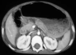 Pancreatic Laceration and Hemoperitoneum - CTisus CT Scan