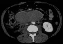 Duodenal Hematoma - CTisus CT Scan