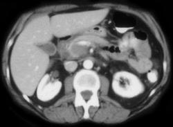 Periduodenal Hematoma - CTisus CT Scan