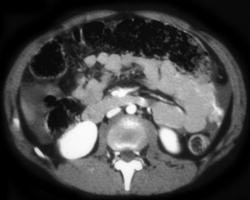 Active Contrast Extravasation From Mesenteric Vessel - CTisus CT Scan