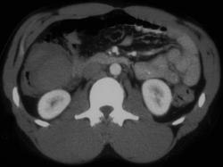 Hematoma in Cecum - CTisus CT Scan