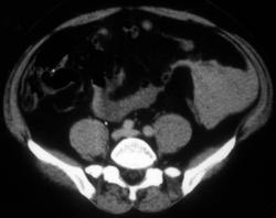 Bleed in Mesentery - CTisus CT Scan