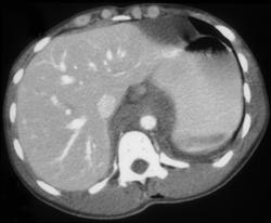 Unsuspected Aortic Injury With Posterior Mediastinal Hematoma - CTisus CT Scan