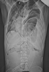 Rupture of the Diaphragm - CTisus CT Scan