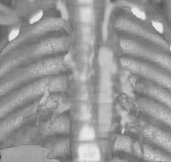 Unsuspected Aortic Arch Tear - CTisus CT Scan