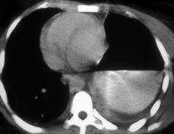 Ruptured Diaphragm - CTisus CT Scan