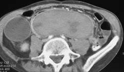 Splenic Laceration - CTisus CT Scan