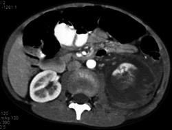 Renal Laceration and Perirenal Bleed - CTisus CT Scan