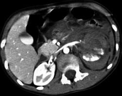 Renal Laceration - CTisus CT Scan