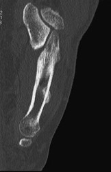 Stress Fracture - CTisus CT Scan