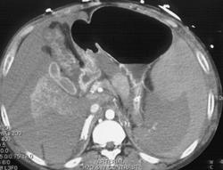 Hemoperitoneum - CTisus CT Scan