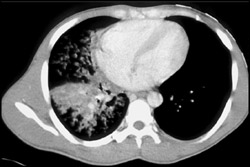 Aspirated Cocaine Bag in Right Lower Lung - CTisus CT Scan