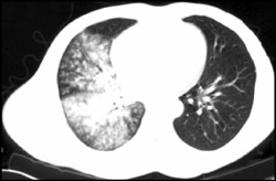 Aspirated Pneumonia (see Prior Image) - CTisus CT Scan