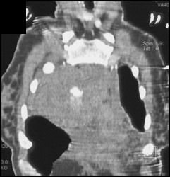 Active Extravasation S/P MVA - CTisus CT Scan