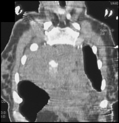 Hepatic Crush Injury - CTisus CT Scan