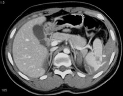 Splenic Laceration - CTisus CT Scan