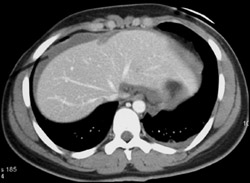 Pneumothorax and Liver Laceration - CTisus CT Scan