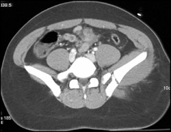 Iliac Wing Fracture - CTisus CT Scan