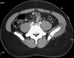 Iliac Wing Fracture With Muscle Hematoma - CTisus CT Scan