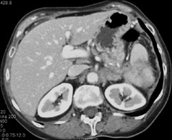 Renal Laceration With Perirenal Hematoma - CTisus CT Scan