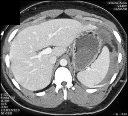 Splenic Laceration - CTisus CT Scan