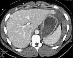 Splenic Laceration - CTisus CT Scan