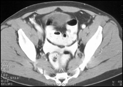 Contrast Extravasation From Bowel Injury - CTisus CT Scan