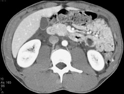 Trauma to Cysterni Chylii - CTisus CT Scan