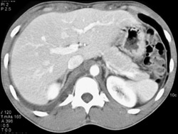 Lymph Due to Injury to Cysterni Chylii - CTisus CT Scan