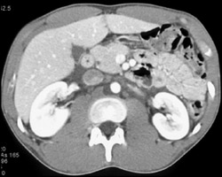 Pneumothorax S/P Trauma - CTisus CT Scan