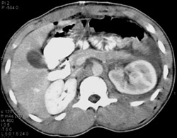 Renal Contusion (left) - CTisus CT Scan