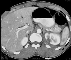 Renal Laceration Due to Stab Wound - CTisus CT Scan