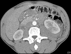 Left Renal Laceration With Bleed - CTisus CT Scan