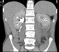 Perirenal Bleed - CTisus CT Scan