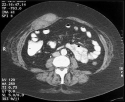 Rectus Hematoma - CTisus CT Scan